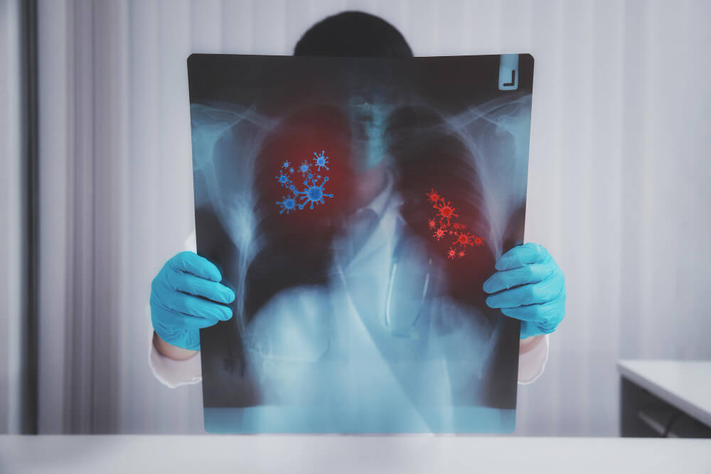 ILTB (Infecção Latente por Tuberculose): o que é, como diagnosticar e o tratamento mais atualizado segundo o PCDT 2024