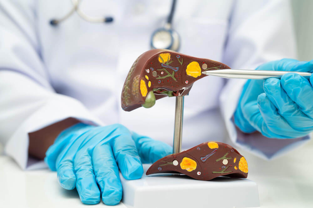 Síndrome hepatorrenal: Novo consenso 2024 muda diagnóstico e tratamento em pacientes com cirrose