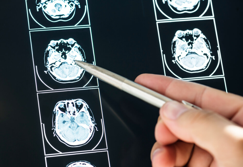 Trombectomia mecânica no AVC isquêmico: indicações, exames e tempo ideal